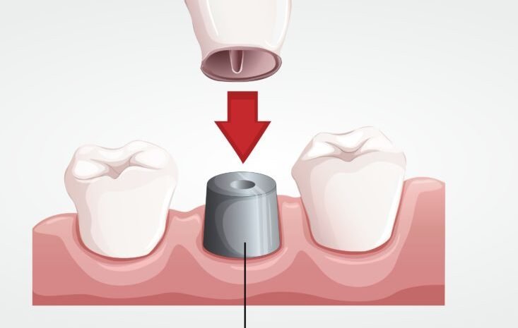 Dental bridges & Crown