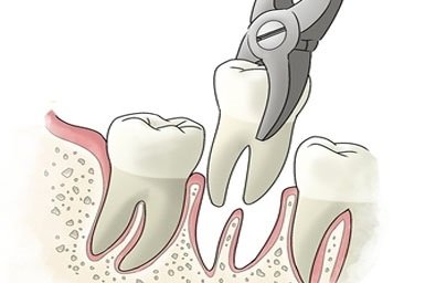 tooth-extraction